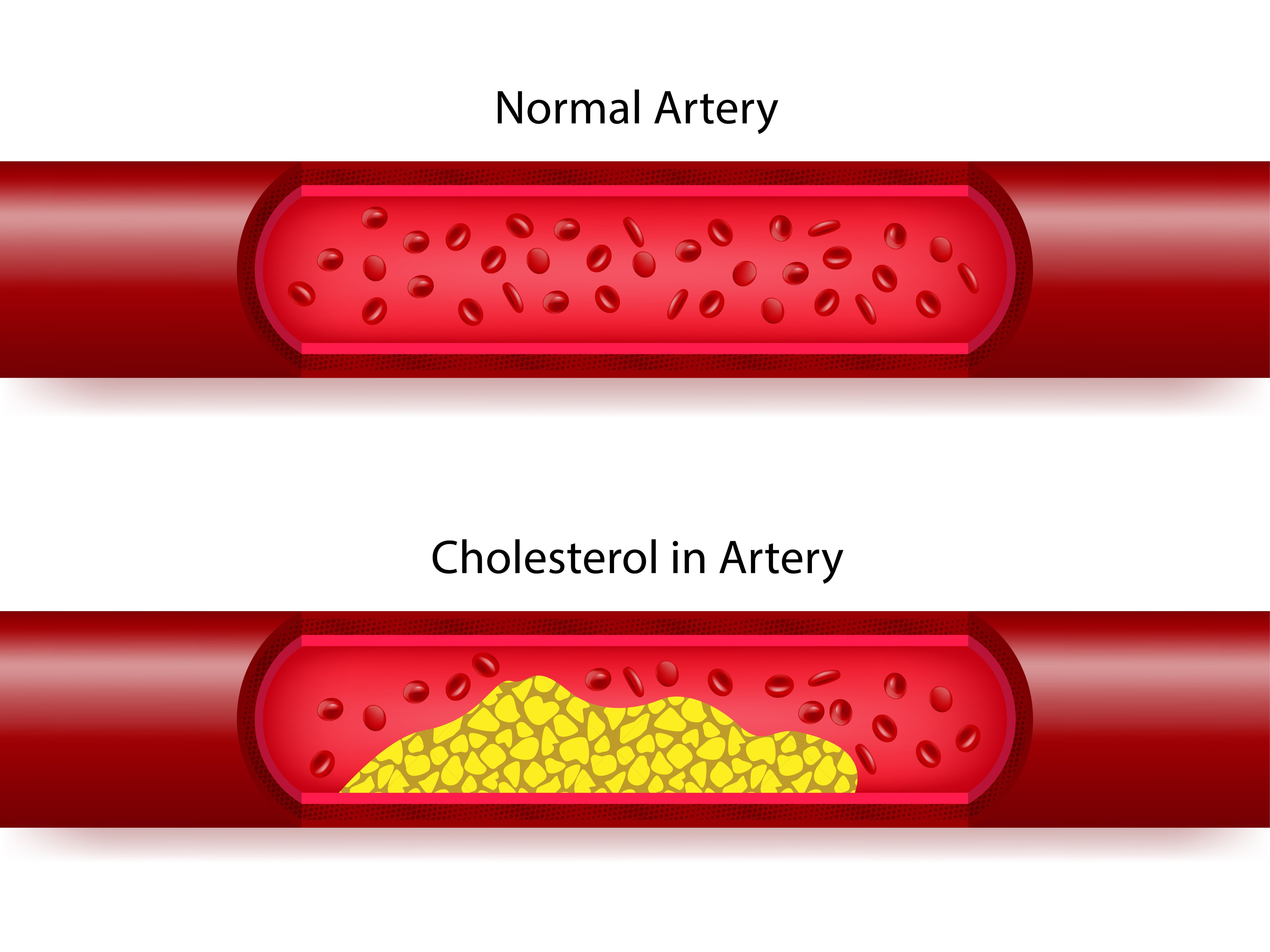 bad cholesterol functional medicine tests