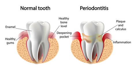 periodontal disease graphic 1-1adobestock